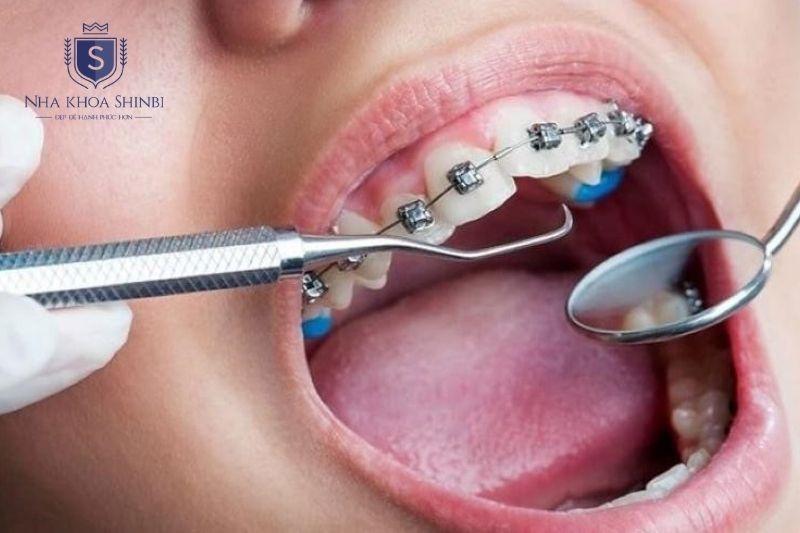 Niềng răng chỉ gây ê buốt theo từng đợt ngắn sau khi siết hoặc thay khay chỉnh nha