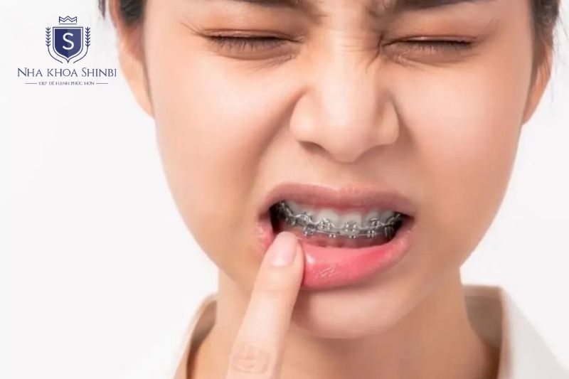 Niềng răng gây ê buốt tạm thời do phản ứng sinh học khi răng di chuyển trong xương hàm