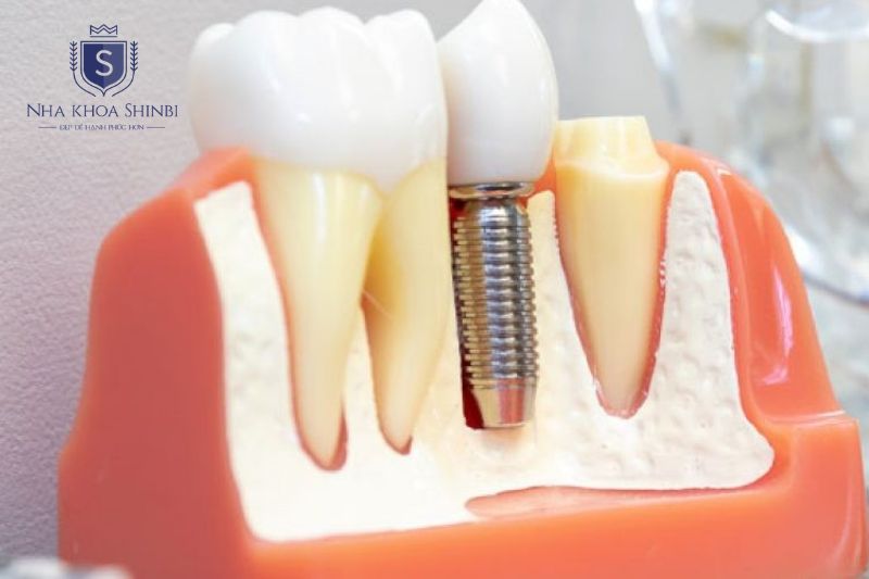 Osstem và Dentium đủ tốt cho xương mật độ bình thường
