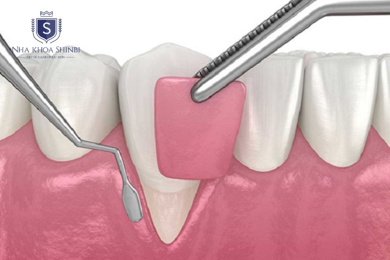Phẫu thuật nha chu giúp làm sạch túi sâu và hỗ trợ tái tạo mô mất