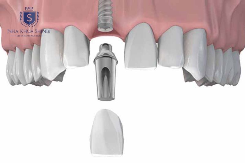 Phương pháp phục hình tức thì cho phép gắn mão sứ tạm ngay trong ngày hoặc sau 7-10 ngày