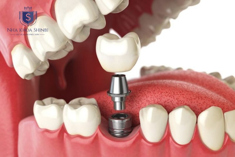 Quy trình cấy ghép trụ Implant Biotem diễn ra tuân theo 4 bước chuẩn
