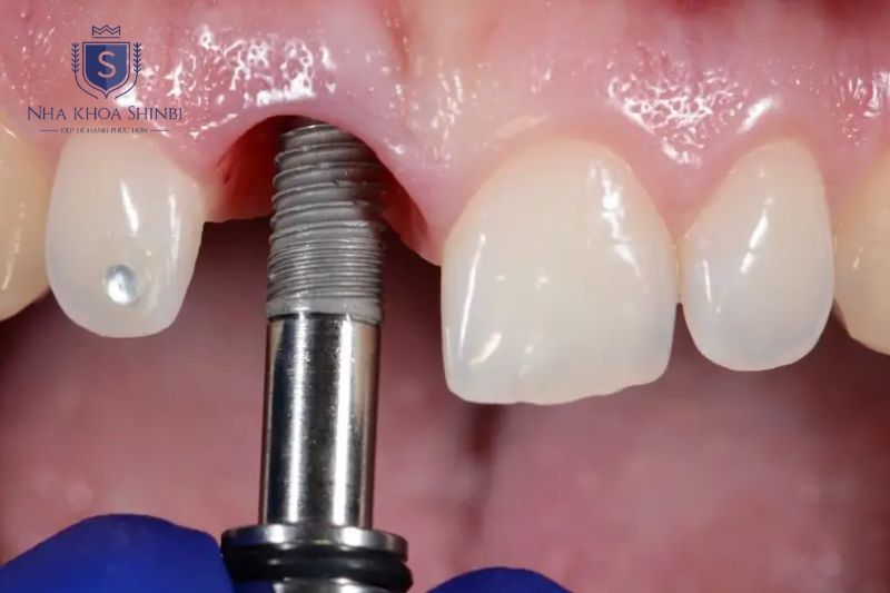 Răng implant lung lay nhận biết qua xê dịch đau kéo dài nướu viêm hôi miệng hoặc mão lỏng