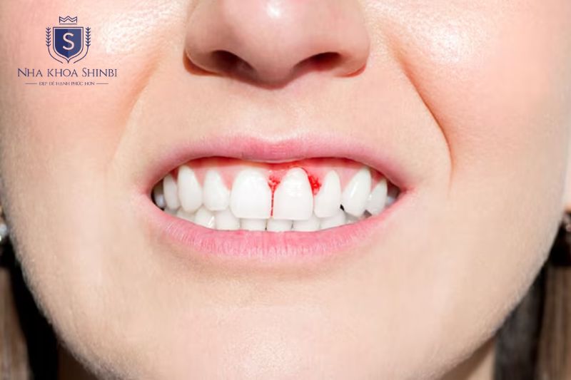 Răng lung lay kèm chảy máu tụt nướu hôi miệng hoặc thay đổi khớp cắn cần chú ý