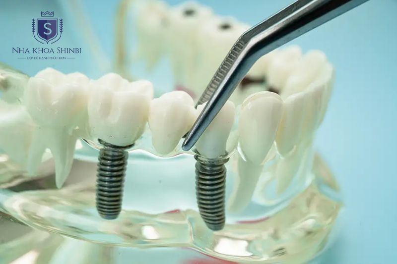 Răng lung lay nặng cần nhổ và phục hình implant để bảo tồn xương hàm lâu dài