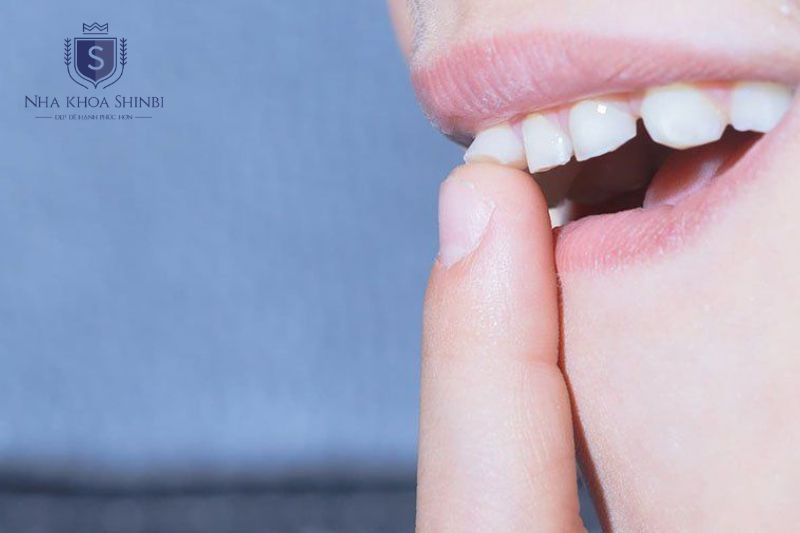 Răng lung lay xảy ra khi cấu trúc nâng đỡ răng bị tổn thương khiến răng mất ổn định