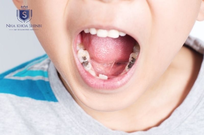 Sâu răng cấm ở trẻ nhỏ cần điều trị sớm vì đây là răng vĩnh viễn không thay lại 