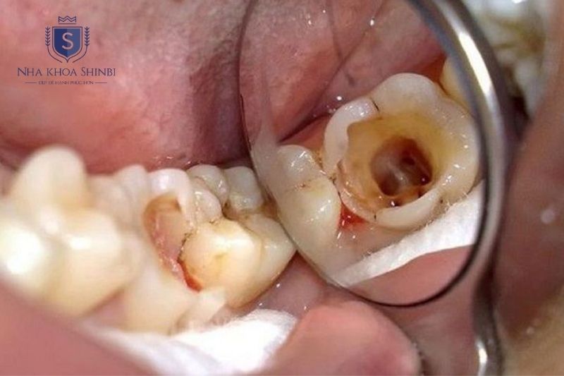 Sâu răng nặng và viêm tủy kéo dài là nguyên nhân phổ biến dẫn đến mất răng số 6