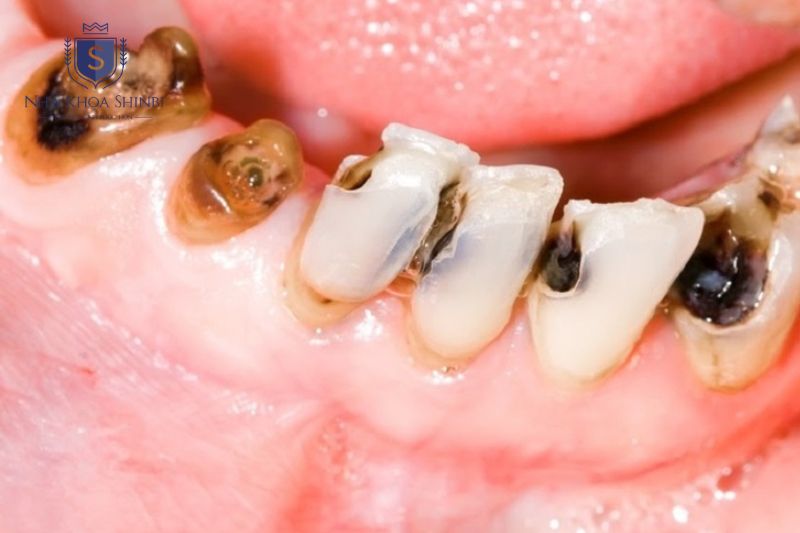 Sâu răng và chấn thương là nguyên nhân phổ biến gây viêm tủy răng
