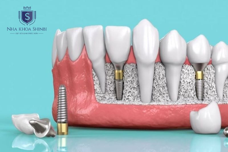 Thân trụ Biotem được làm từ titanium nguyên chất