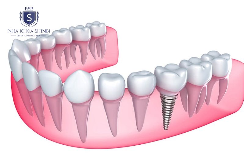 Thời gian 3-6 tháng là giai đoạn xương hàm phát triển và cố định xung quanh toàn bộ bề mặt trụ
