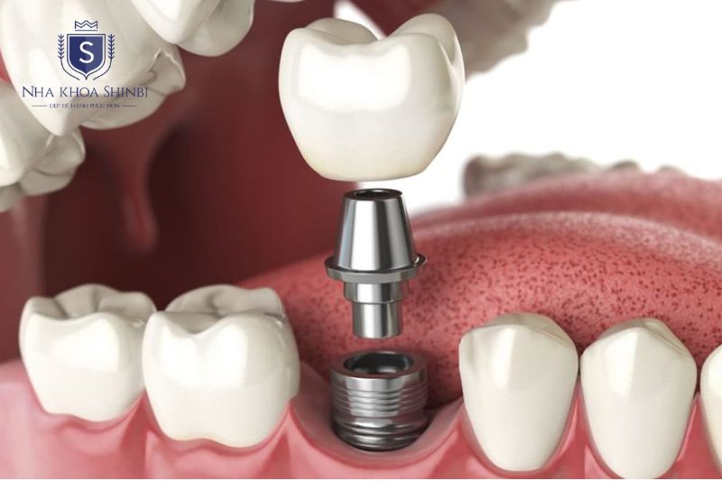 Thời gian cấy ghép implant hoàn thiện tùy mật độ xương hàm và loại trụ sử dụng