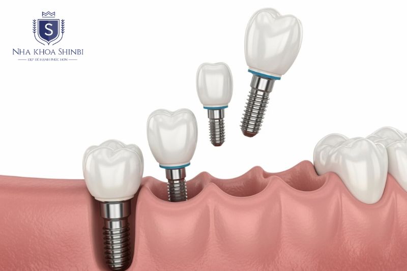 Thời gian cấy implant dựa trên số lượng trụ implant cần cấy