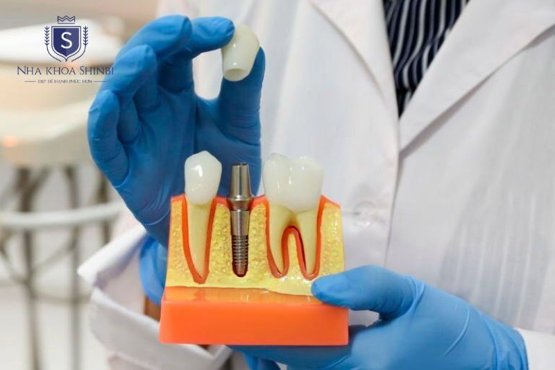 Thời gian phục hình Implant Hiossen dài hơn một số dòng trụ cùng phân khúc