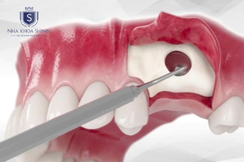 Thủng xoang hàm thường liên quan thiếu đánh giá xương trước cấy ghép implant