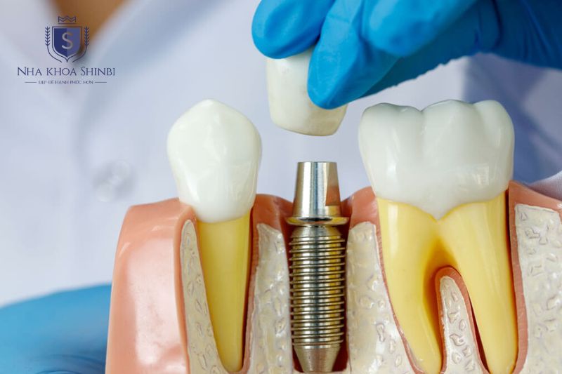 Thụy Sĩ Là Cái Nôi Của Công Nghệ Implant Nha Khoa