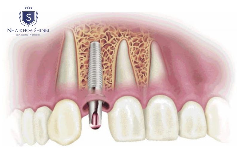 Tích hợp xương Implant kéo dài 3 đến 6 tháng tùy vị trí hàm