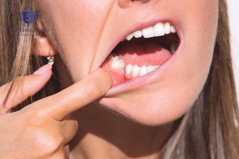 Tiêu xương hàm làm mất nền nâng đỡ khiến răng xô lệch và lung lay
