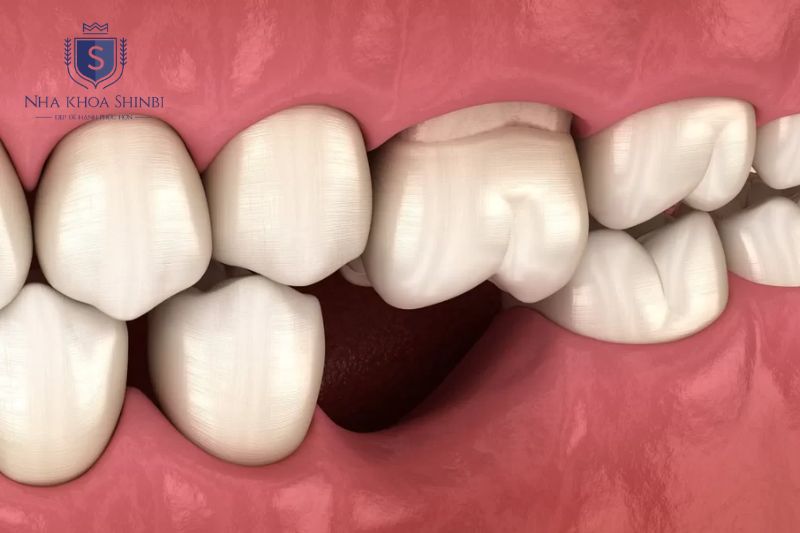 Tiêu xương hàm thường không đau trong giai đoạn sớm