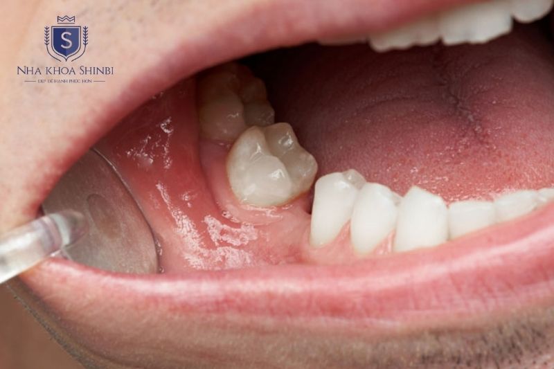 Tiêu xương quanh implant tiến triển nhanh nếu viêm nhiễm không được kiểm soát