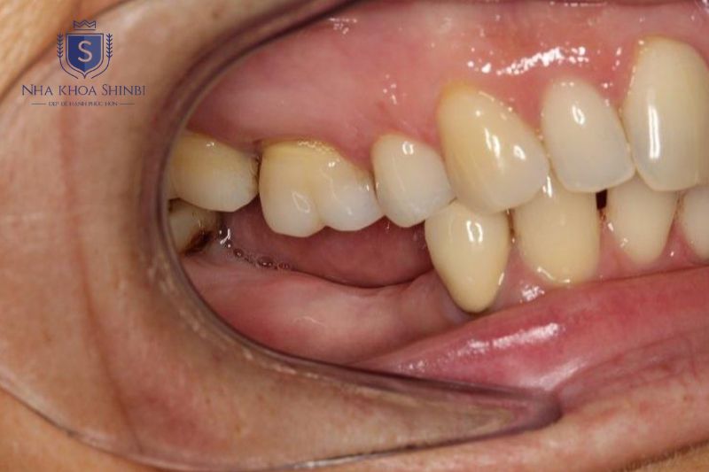 Tiêu xương theo chiều ngang khiến răng kế cận xô lệch và mất cân đối cung hàm