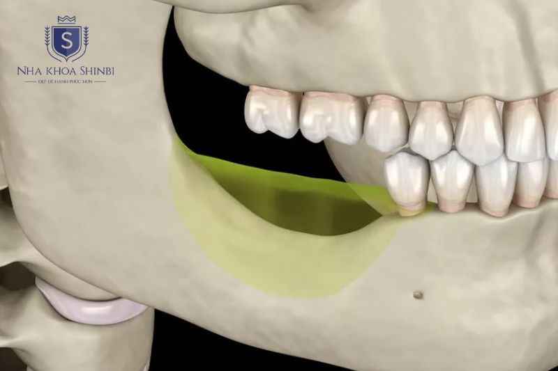 Tiêu xương toàn hàm làm má hóp, da chảy xệ và khuôn mặt già hơn tuổi thật