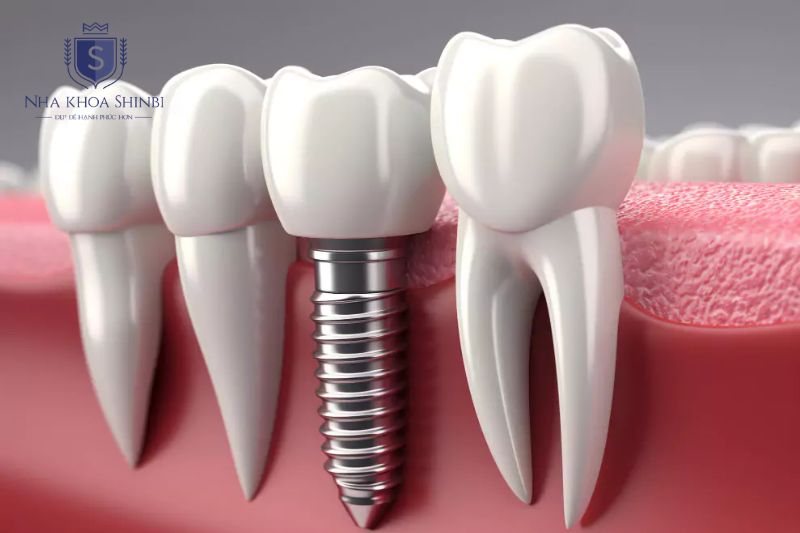 Trồng răng Implant cấy trụ titanium vào xương hàm thay thế chân răng tự nhiên