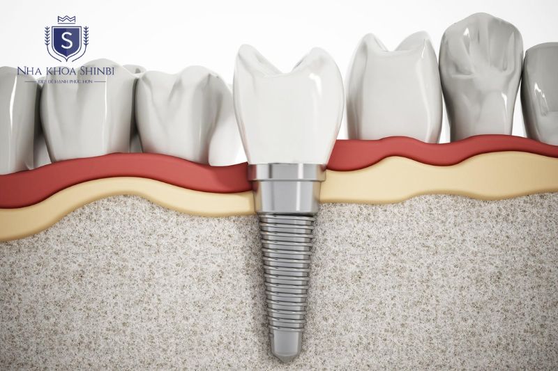 Trồng răng Implant có chi phí cao, thời gian điều trị dài và cần phẫu thuật phù hợp sức khỏe