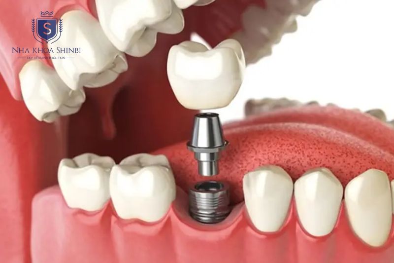Trồng răng Implant gây đau nhẹ, hồi phục mô mềm và tích hợp xương