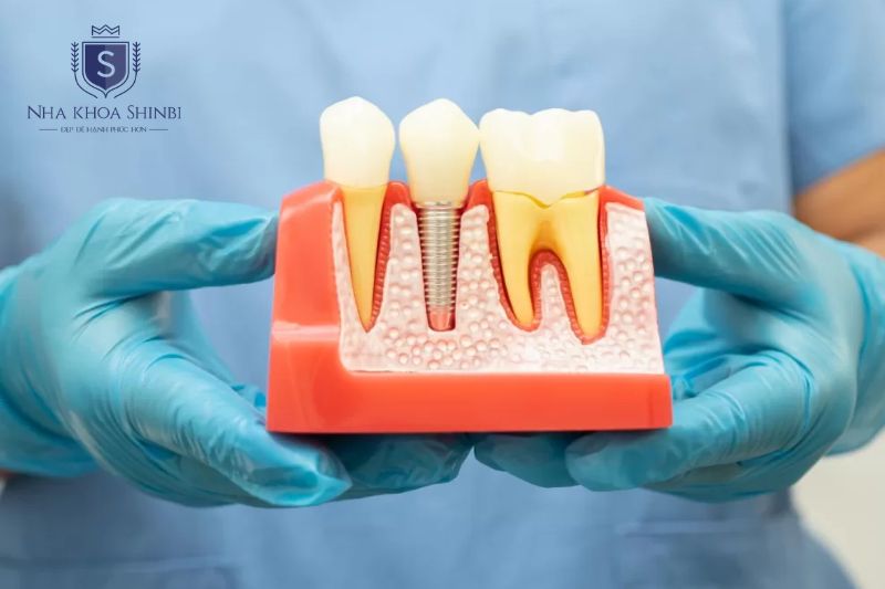Trồng răng hàm Implant là cấy ghép răng thay thế tại vùng răng hàm chịu lực nhai chính