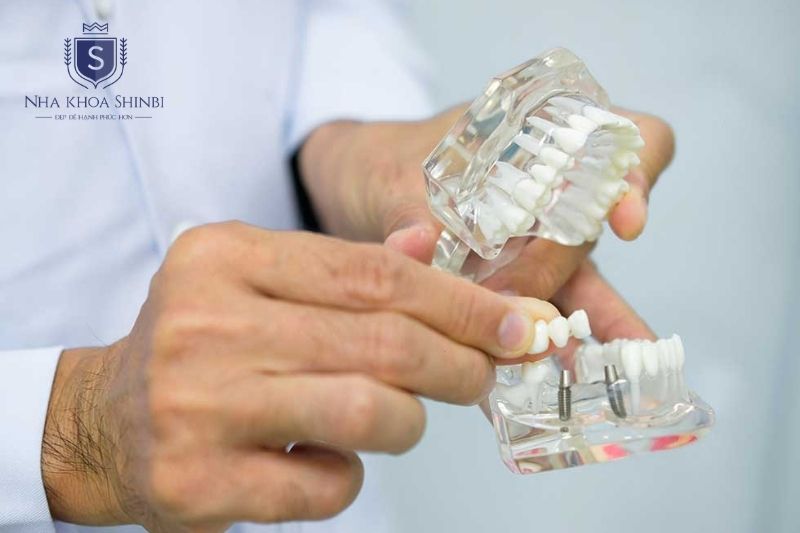 Trồng răng implant được chỉ định khi mất răng do viêm nha chu và tiêu xương hàm