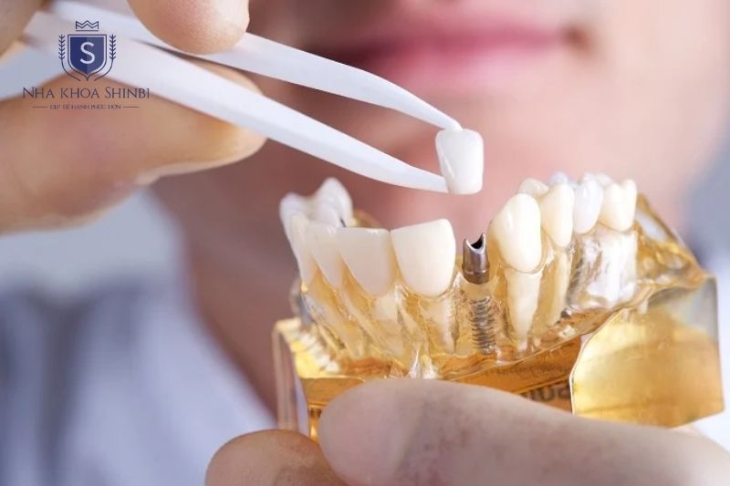 Trồng răng implant giúp phục hồi lực nhai và hạn chế tiêu xương hàm sau mất răng