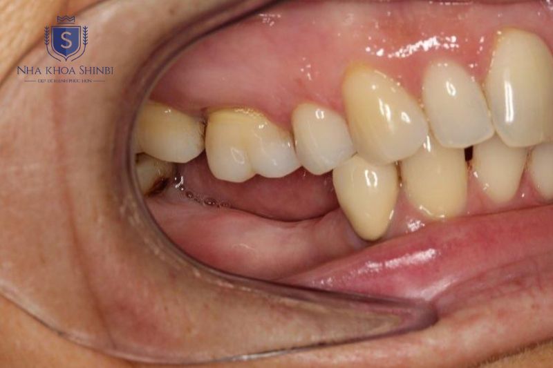 Trụ Hàn Quốc cần cân nhắc ở ca tiêu xương nặng, bệnh lý xương hoặc hút thuốc lá