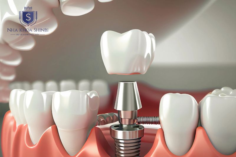 Trụ Hiossen nổi bật với nhiều ưu điểm được ghi nhận trong thực tế lâm sàng