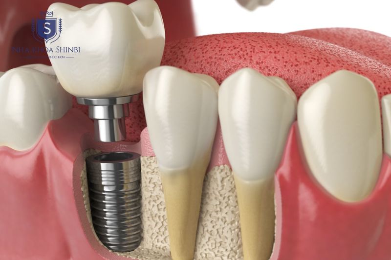 Trụ Implant Biotem có 2 giới hạn kỹ thuật rõ ràng mà bác sĩ thường cân nhắc