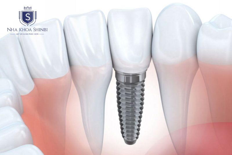Trụ Implant Biotem có 4 ưu điểm được ghi nhận qua quá trình ứng dụng thực tế