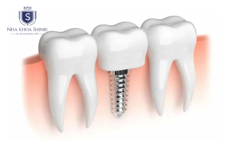 Trụ Implant titanium có thể bền lâu dài nếu tích hợp xương tốt và chăm sóc đúng cách