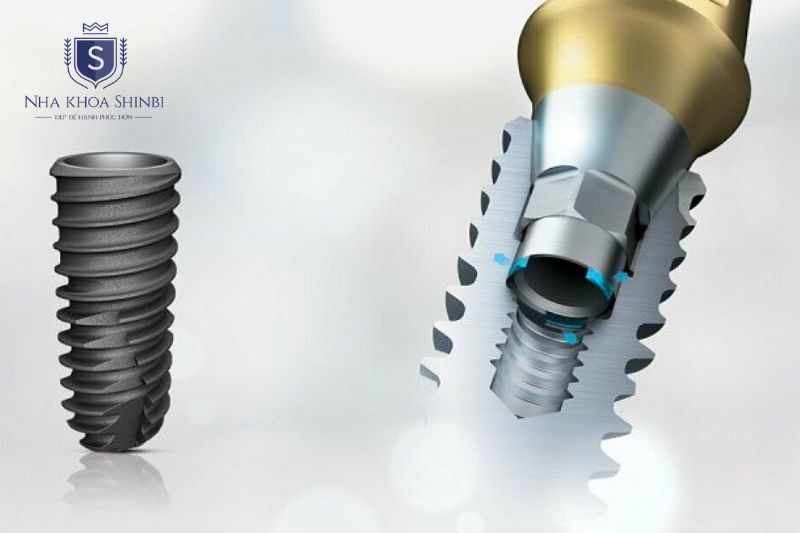 Trụ implant Hàn Quốc có ưu điểm chi phí hợp lý, tích hợp nhanh nhưng hạn chế ở bảo hành và ca phức tạp