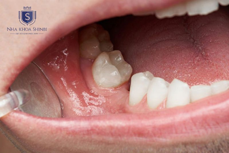 Trụ implant Hàn Quốc phù hợp mất răng đơn lẻ, xương hàm tốt và ngân sách tối ưu