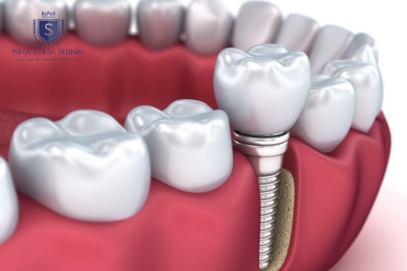 Trụ implant Mỹ là loại trụ Titanium được sản xuất và nghiên cứu tại Hoa Kỳ