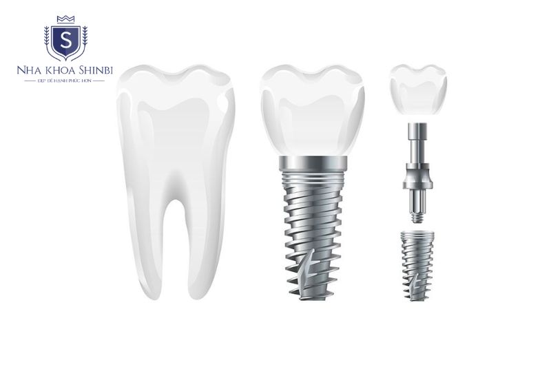 Trụ implant là phần cắm trực tiếp vào xương hàm, thay thế chân răng tự nhiên đã mất