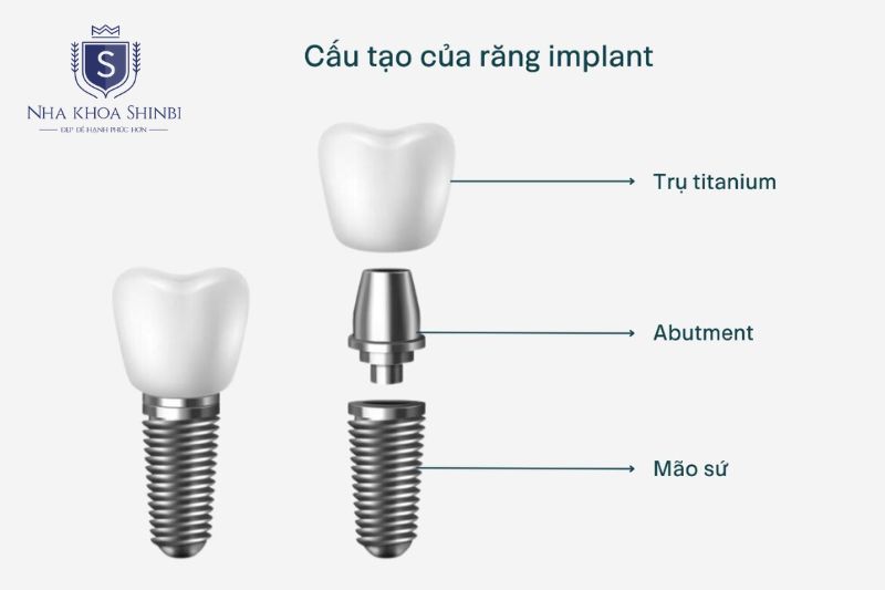 Trụ implant tạo liên kết sinh học trực tiếp với xương hàm hay vì dựa vào răng kế cận hoặc nướu