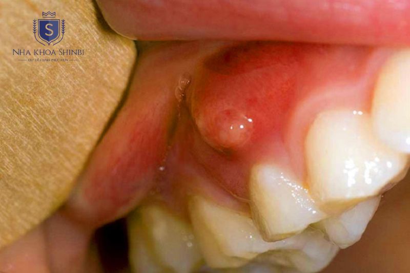 Tự nặn mủ dùng kháng sinh và chườm nóng có thể làm áp xe răng nặng hơn