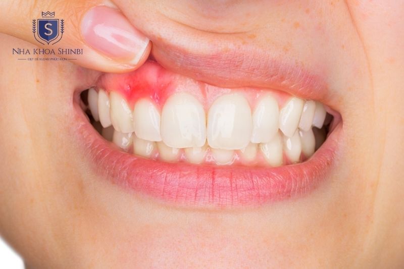 Viêm lợi giai đoạn đầu có thể hồi phục nếu làm sạch mảng bám và cao răng kịp thời