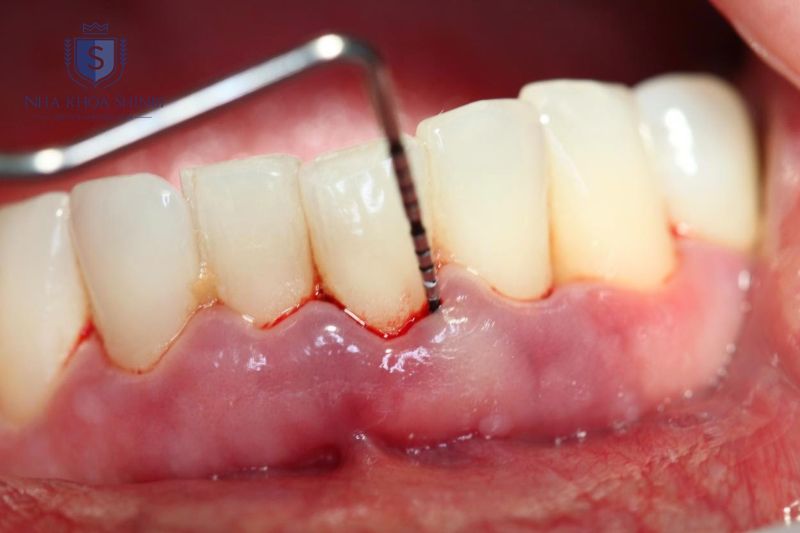 Viêm nha chu cấp và mạn tính có biểu hiện và mức độ nguy hiểm khác nhau