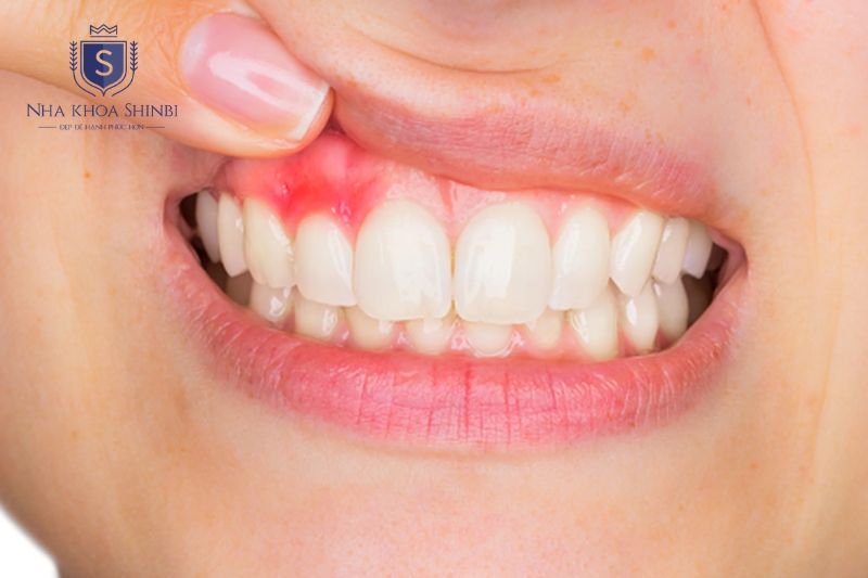 Viêm nha chu do mảng bám tích tụ phá hủy mô nâng đỡ gây lung lay răng