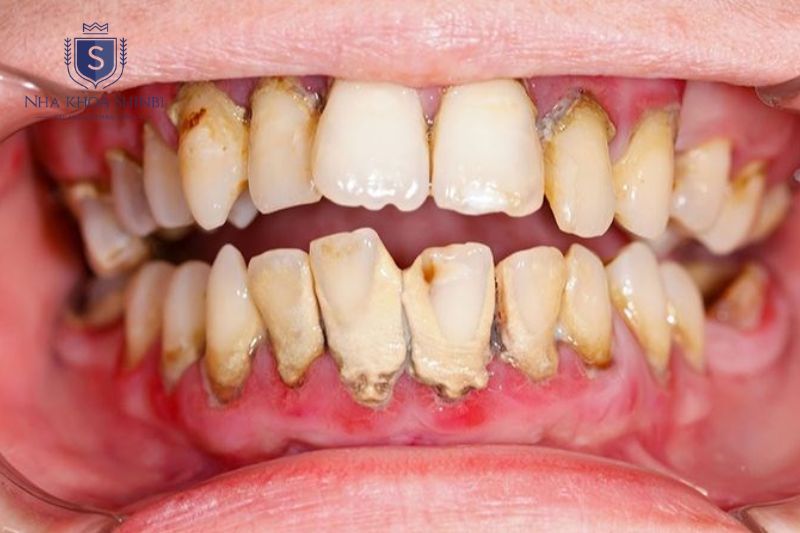 Viêm nha chu gây tiêu xương hàm và mất răng nếu không điều trị kịp thời
