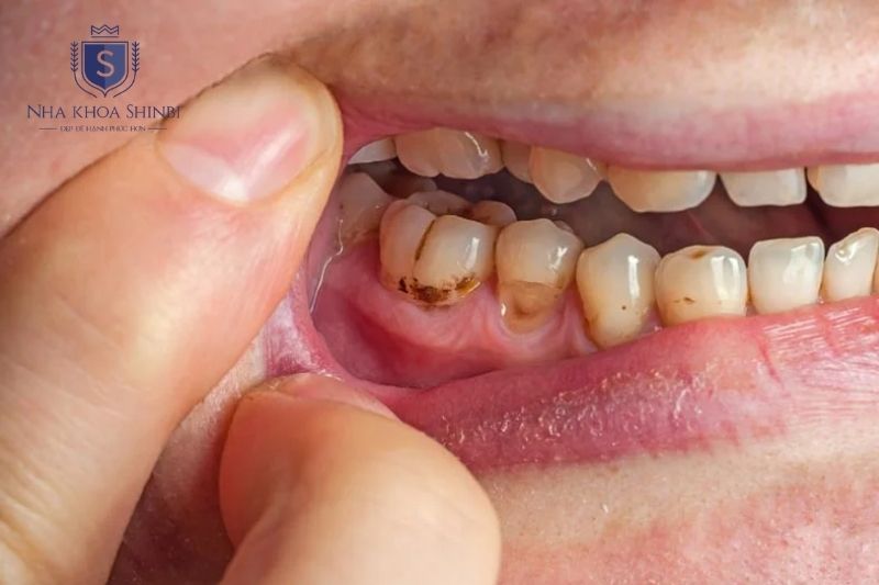 Viêm nha chu nặng cần điều trị lâu dài và tái khám định kỳ để kiểm soát 