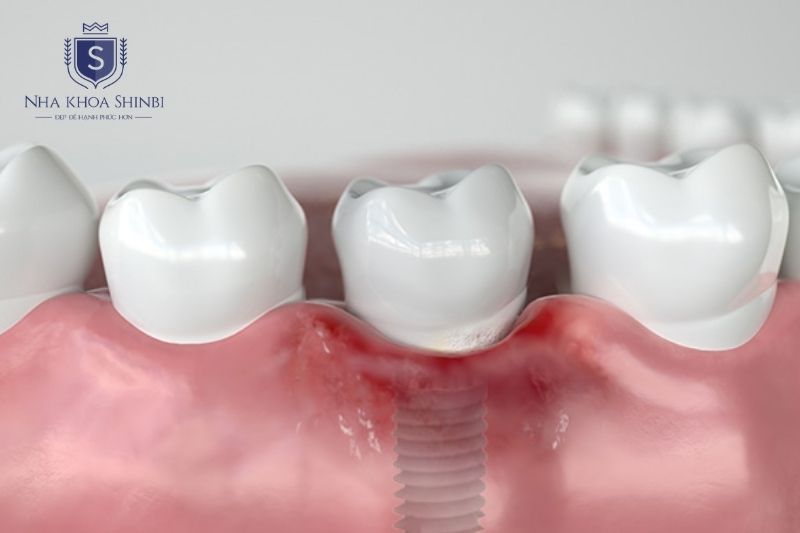 Viêm nhiễm implant thường xuất phát từ vô trùng kém và vệ sinh không đúng