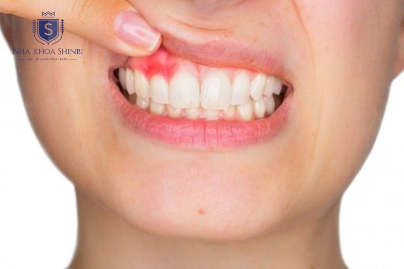 Viêm nướu, viêm nha chu hoặc viêm xoang hàm phải được điều trị trước khi tiến hành cấy trụ